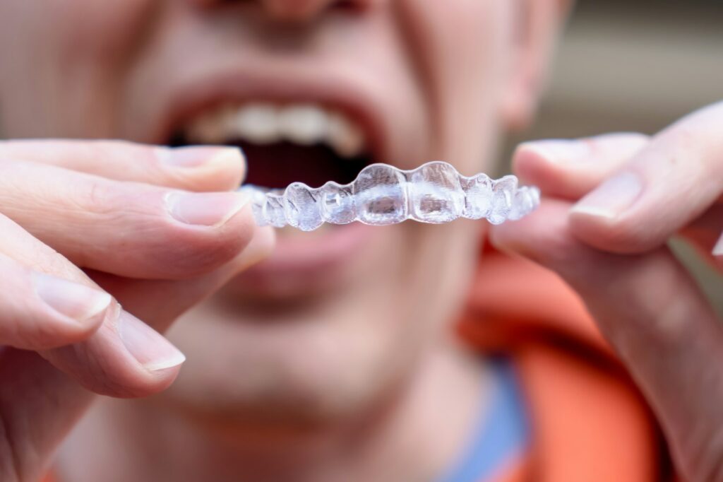 Man holds put on invisible braces. Invisalign plastic removable braces